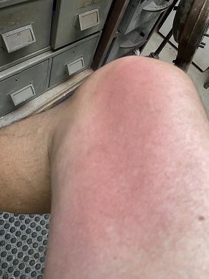 TIG leg.JPG